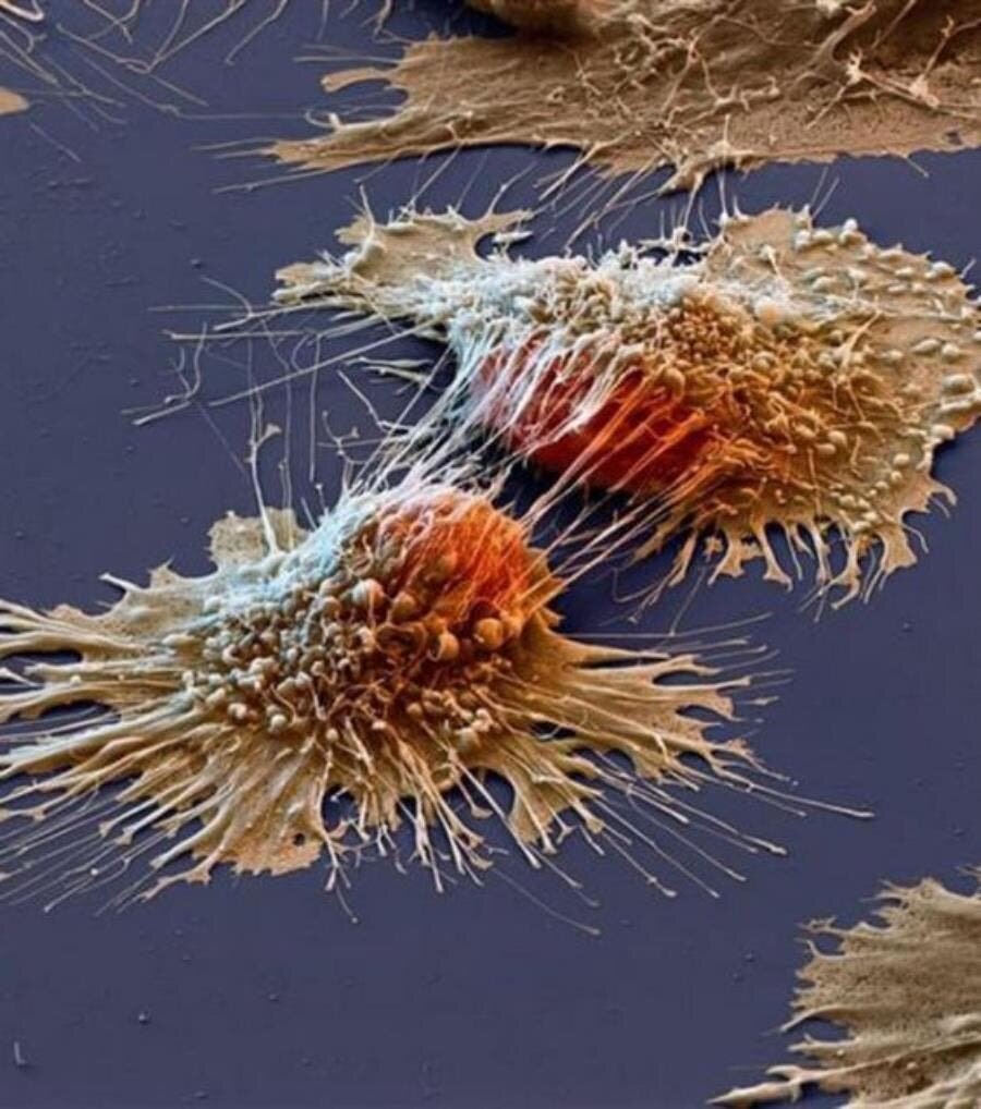 cancer, cellule, immonde, microscope