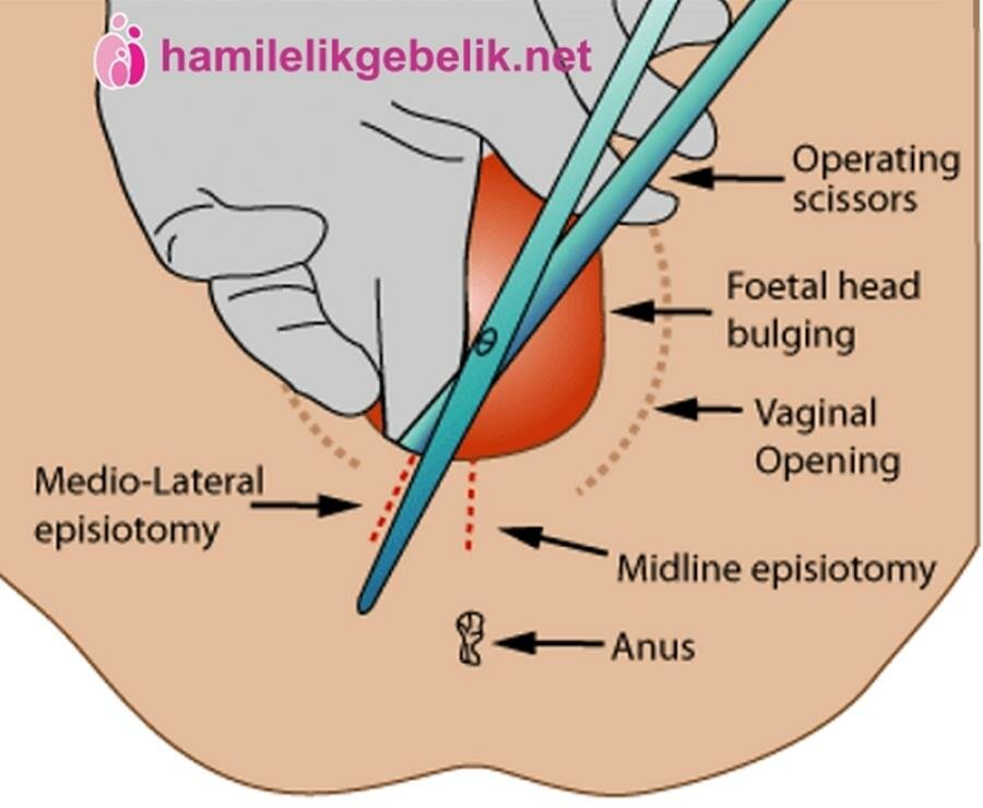 épisiotomie