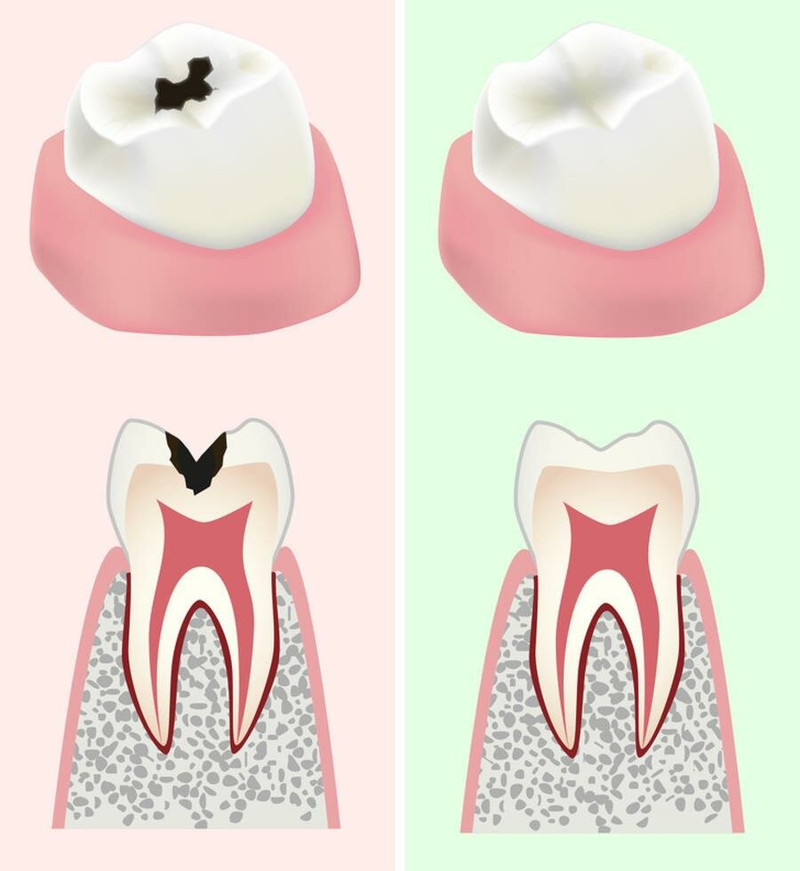 dents, résistantes