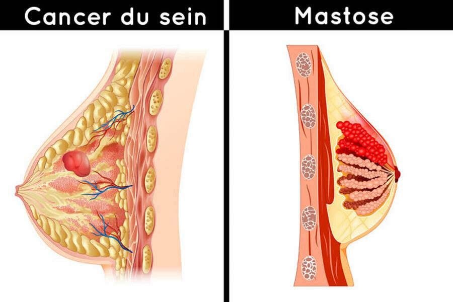 symptÃ´mes, maladie, sein