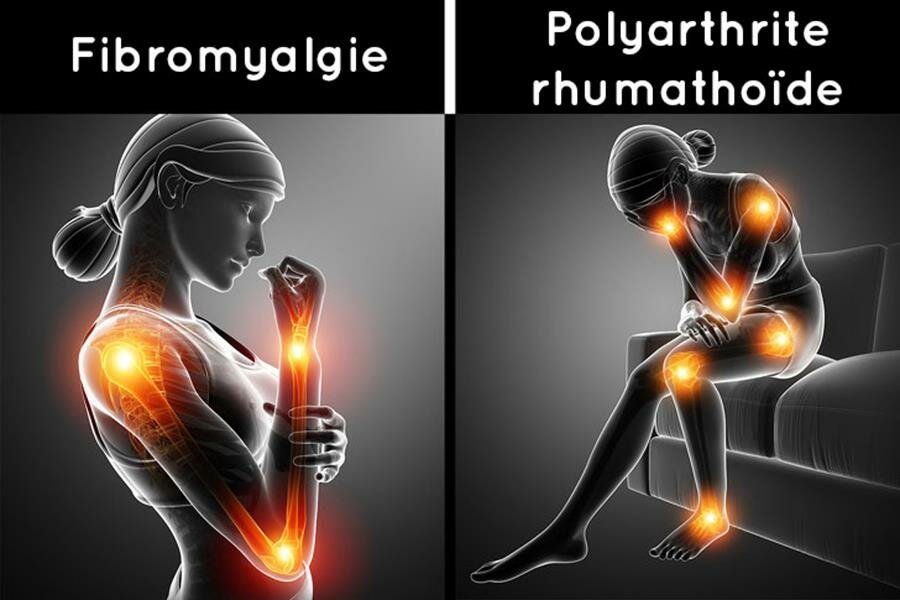 fibromyalgie, polyarthrite rhumatoÃ¯de