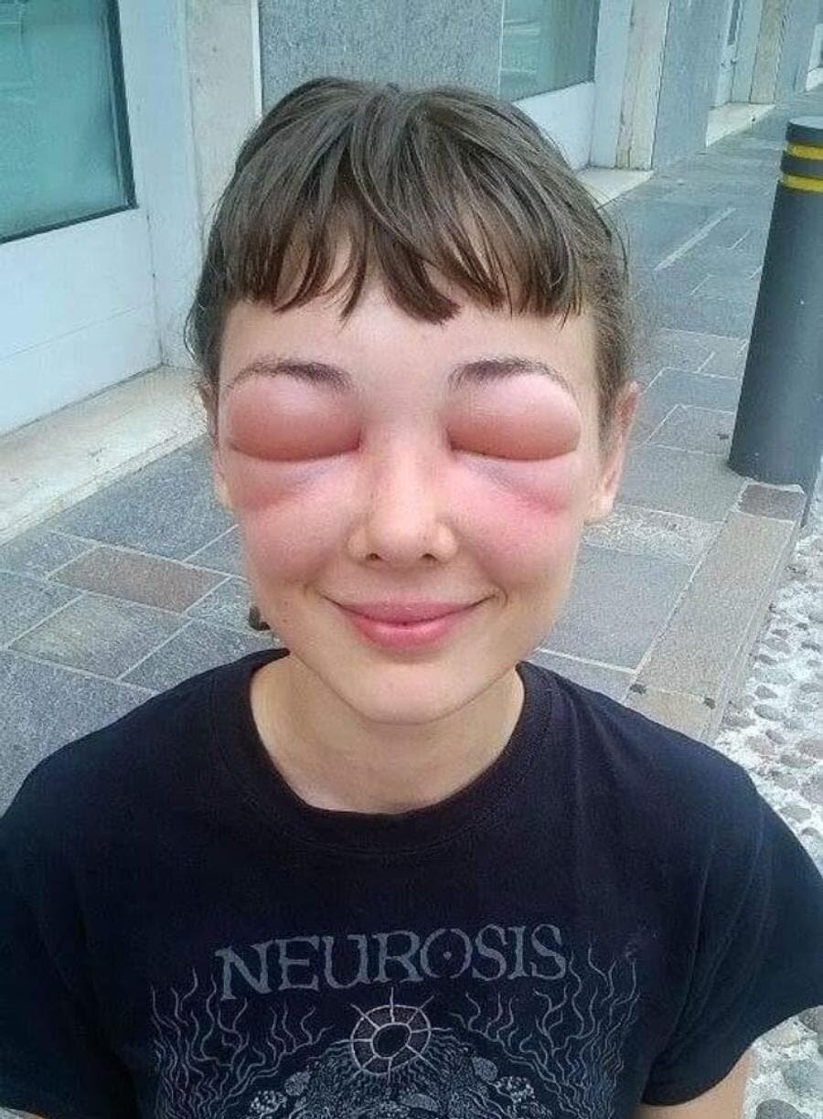 abeille, insolite, humour, allergique, wtf, douleur