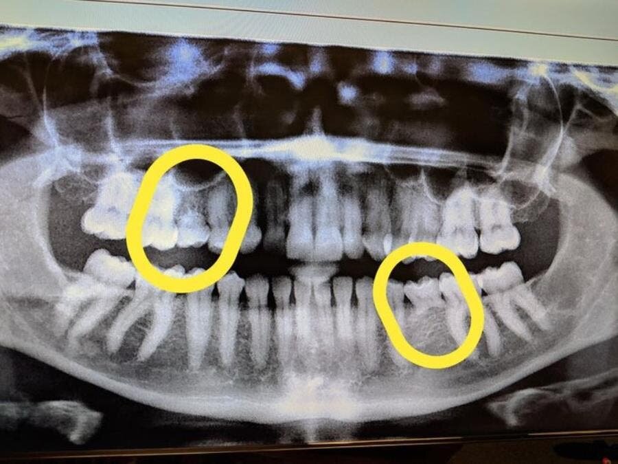 dents, lait, définitive, gencives, radiographie