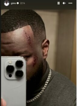 Maitre Gims Le Visage En Sang Ses Fans Sont En Panique